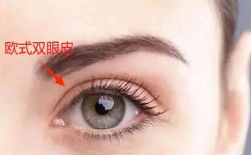 欧式双眼皮手术费用解析：你需要多少钱?